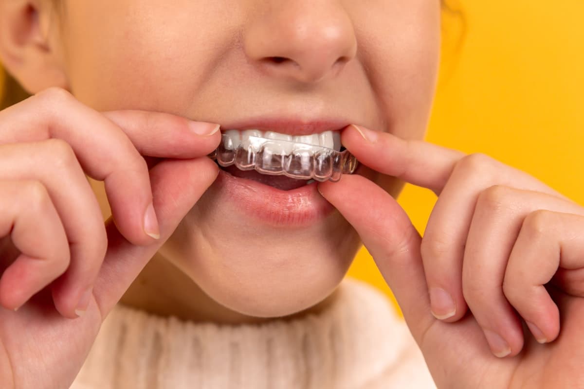 O clareamento tira o esmalte dos dentes?